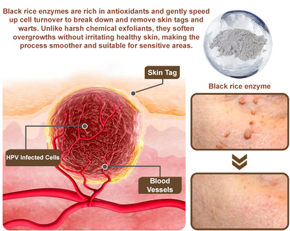 🌊🐡Zvoevo® Black Rice Skin Repair Essence Cream ⚕️ FDA Certified (Removes warts and skin growths, improves keratin buildup and seborrheic dermatitis, follicular keratosis, age spots, and bruising)