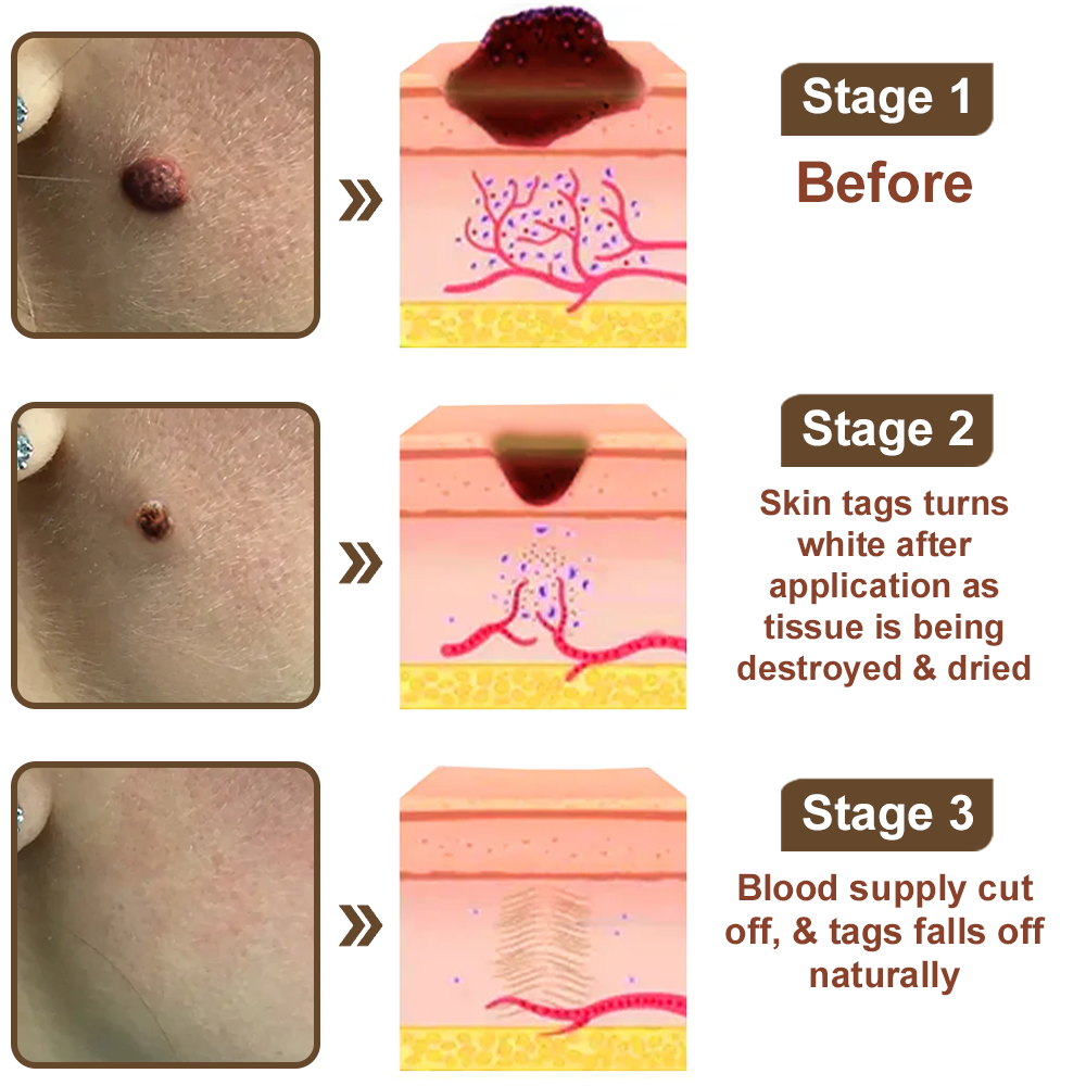 🌊🐡Zvoevo® Black Rice Skin Repair Essence Cream ⚕️ FDA Certified (Removes warts and skin growths, improves keratin buildup and seborrheic dermatitis, follicular keratosis, age spots, and bruising)